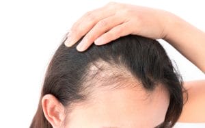 understanding hair loss